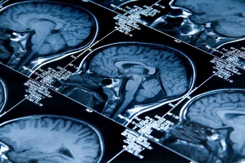 In Alzheimer’s, DNA errors stress cells, create dysfunction
