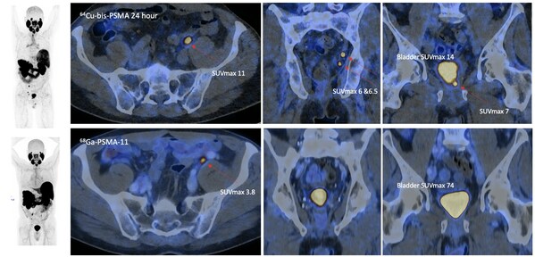 前列腺癌精准诊断新突破：新型显像剂64Cu-SAR-bisPSMA在生化复发检测中表现卓越
