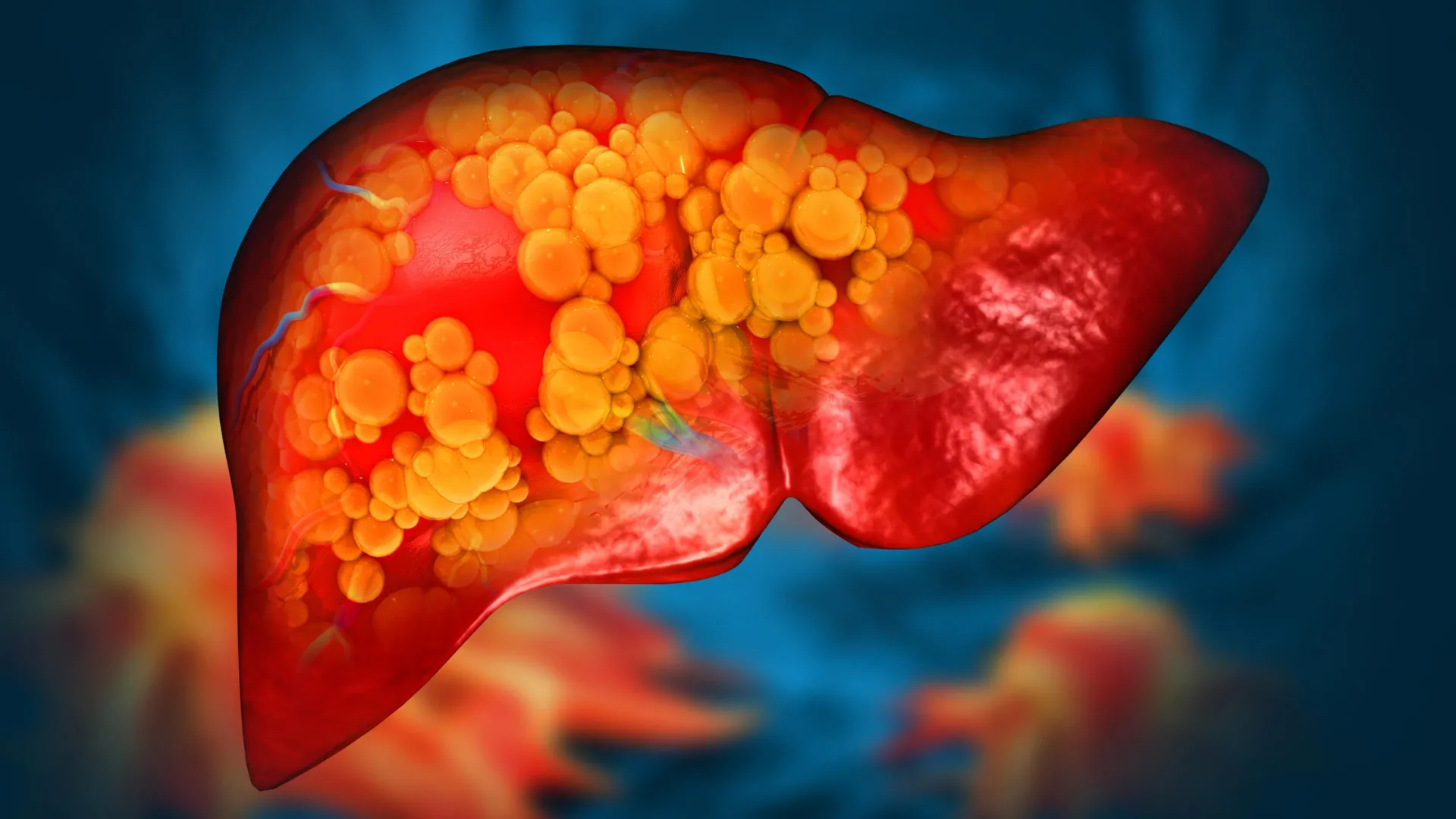 Binge Drinking Just Once a Month May Triple Your Risk of Liver Scarring