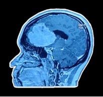 Breakthrough in Brain Cancer: Survival in High-Grade Gliomas Improves by Up to 50%, Some Patients Surviving Over 10 Years
