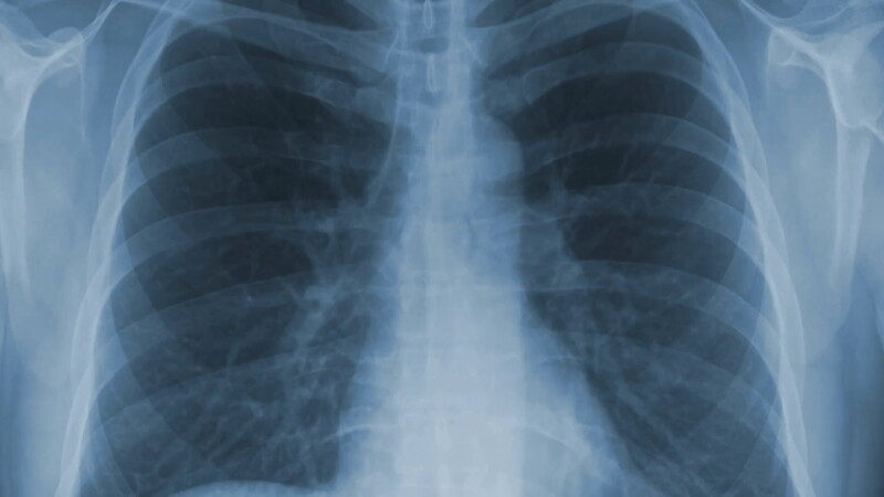 Annual Lung Cancer Screenings Can Save Lives, Doctors Urge High-Risk Adults