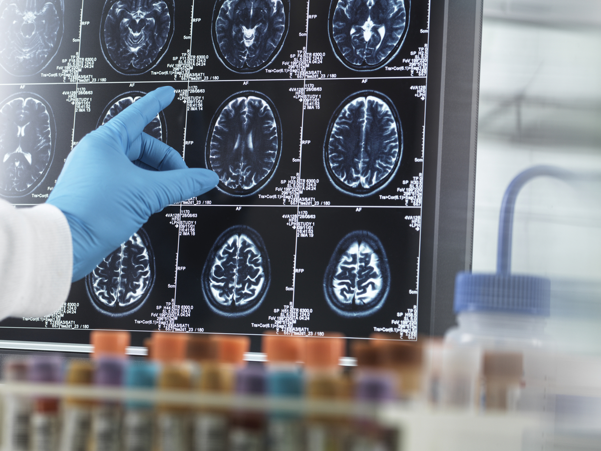 Exercise-Linked Irisin Levels May Signal Early Alzheimer's Risk, Korean Study Finds