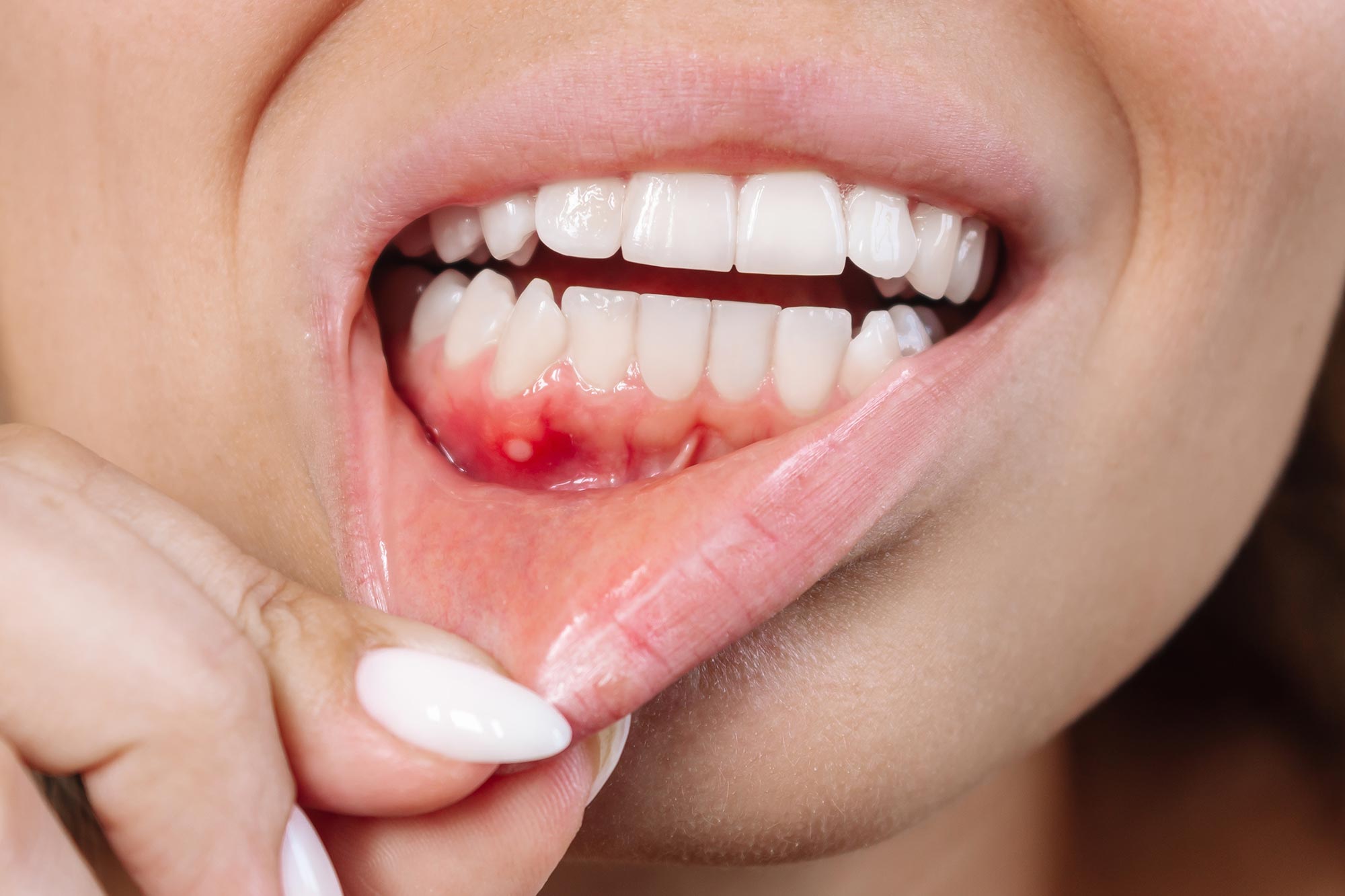Omega-3 and Low-Dose Aspirin Show Antibiotic-Like Benefits for Severe Gum Disease