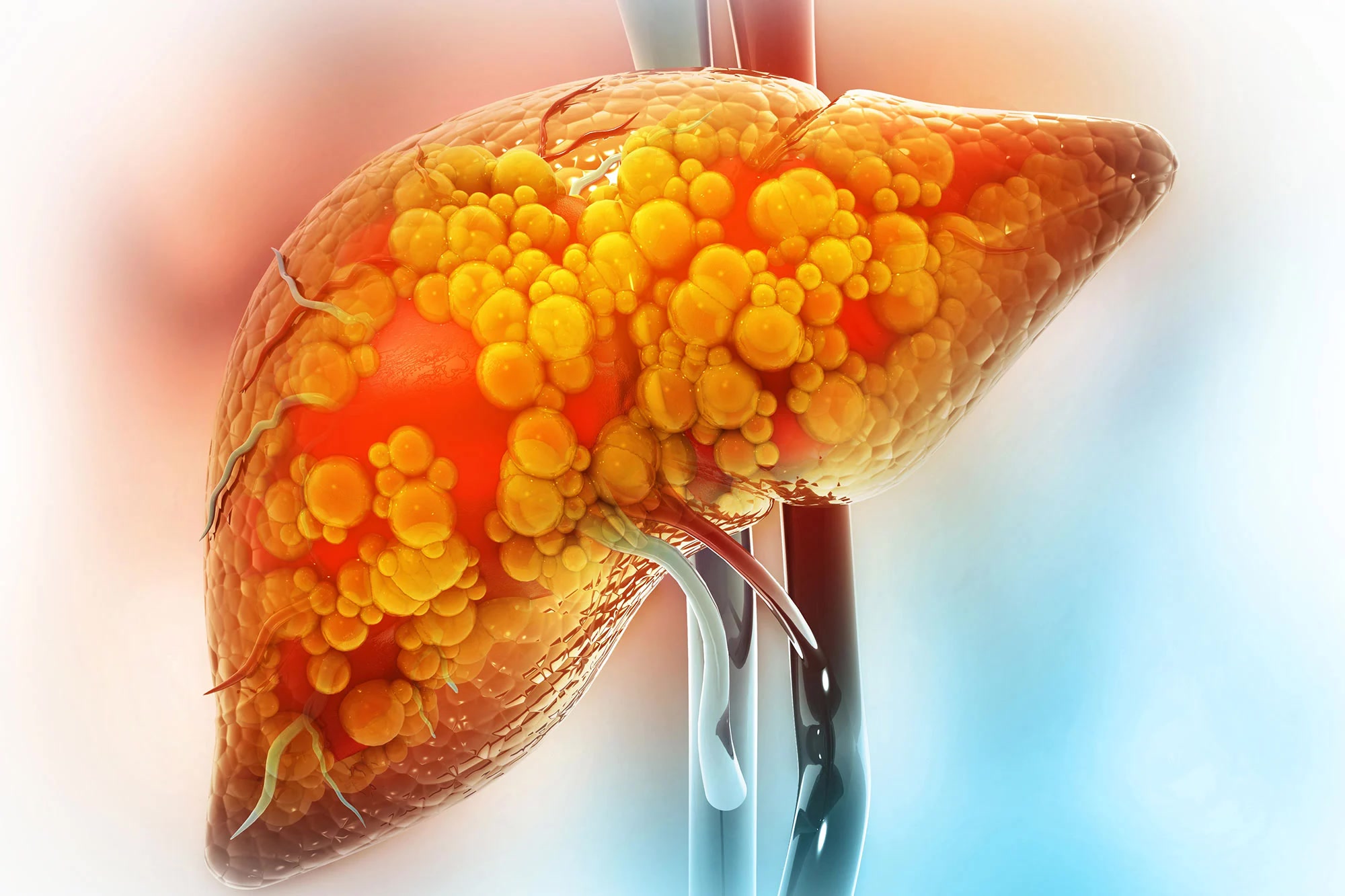 Scientists Discover 5 Hidden Forms of Fatty Liver Disease Affecting 30% of Adults